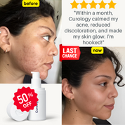 Custom Formula for acne