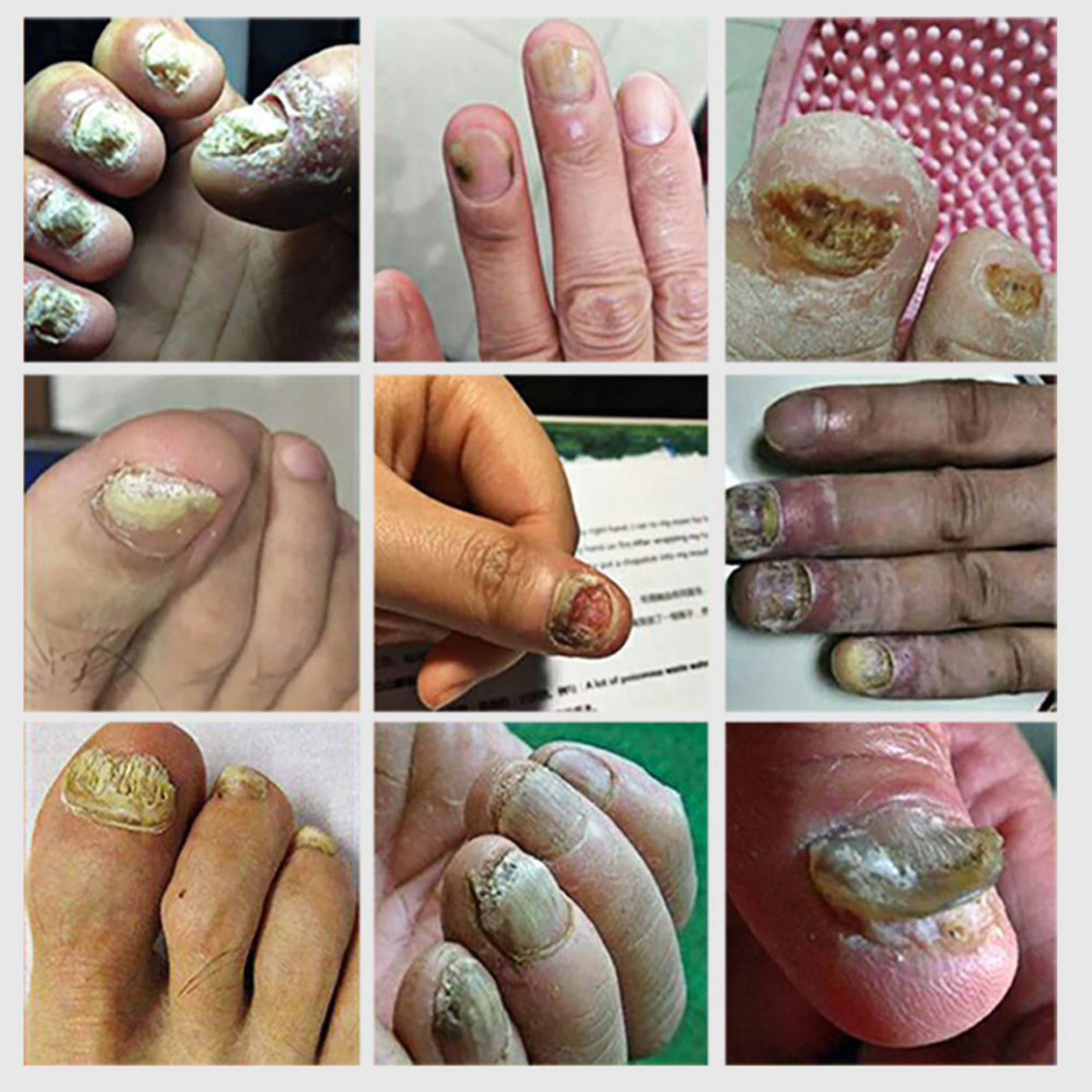 Nail Fungix